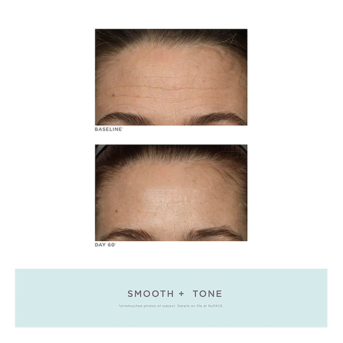 Trinity Facial Toning Device + Wrinkle Reducer Attachment Bundle O385
