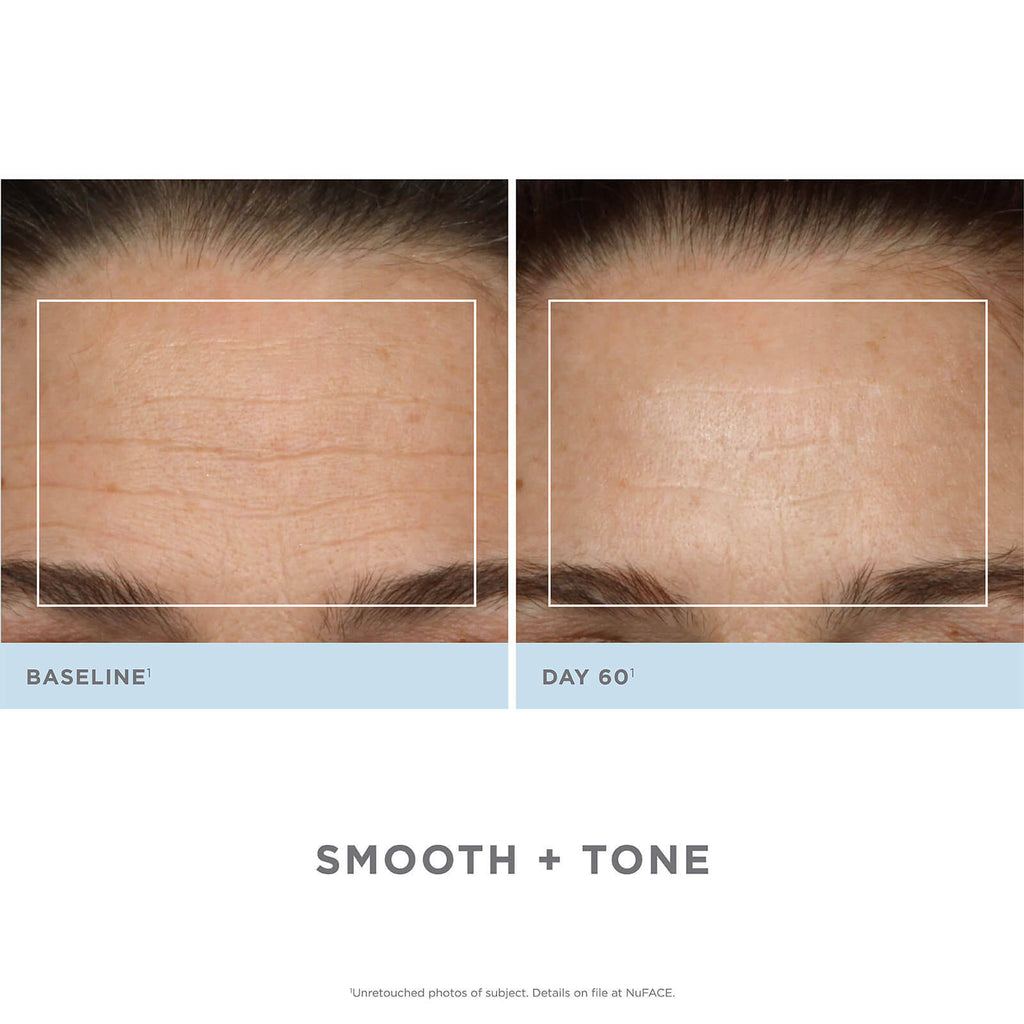 Trinity Facial Toning Device + Wrinkle Reducer Attachment Bundle O385