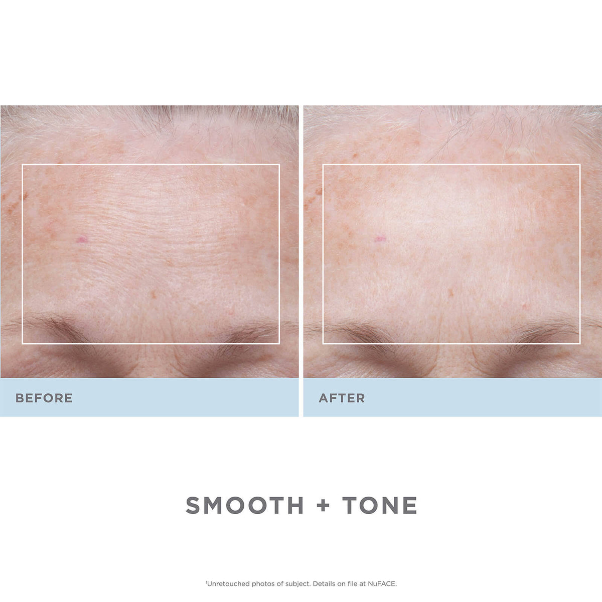 Trinity Facial Toning Device + Wrinkle Reducer Attachment Bundle O385